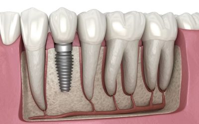 Dental Implant Recovery Process and Tips