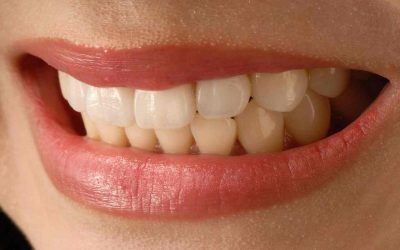 Porcelain Veneers vs. Composite Veneers