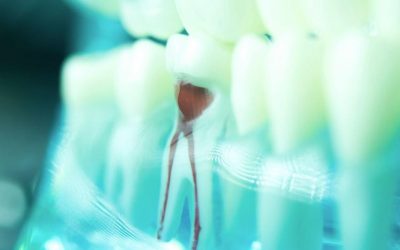 What to Expect With Root Canal Therapy