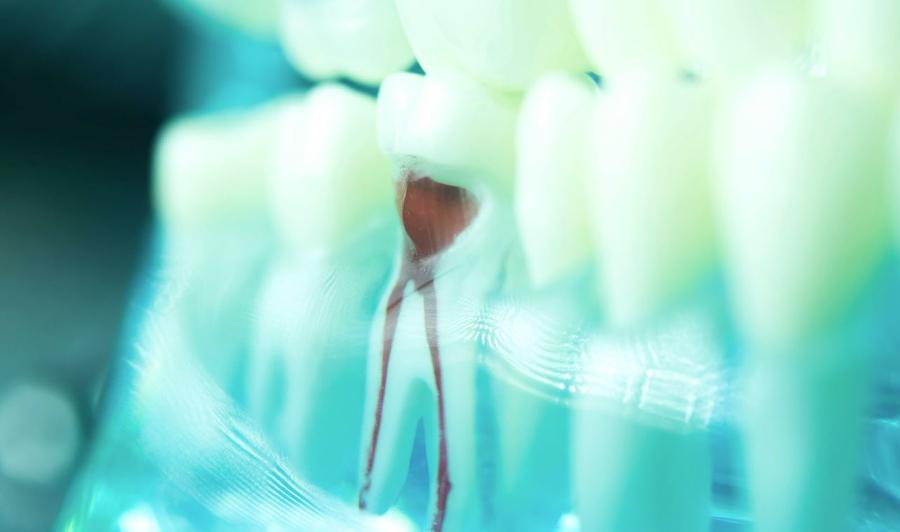 root canal