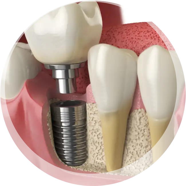 dental implants near me