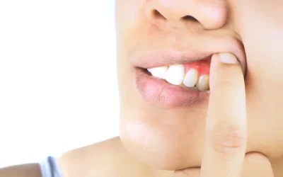 Reasons Why Your Gums Are Bleeding
