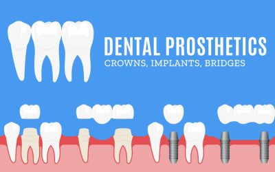How Do Dental Crowns and Bridges Work Together?