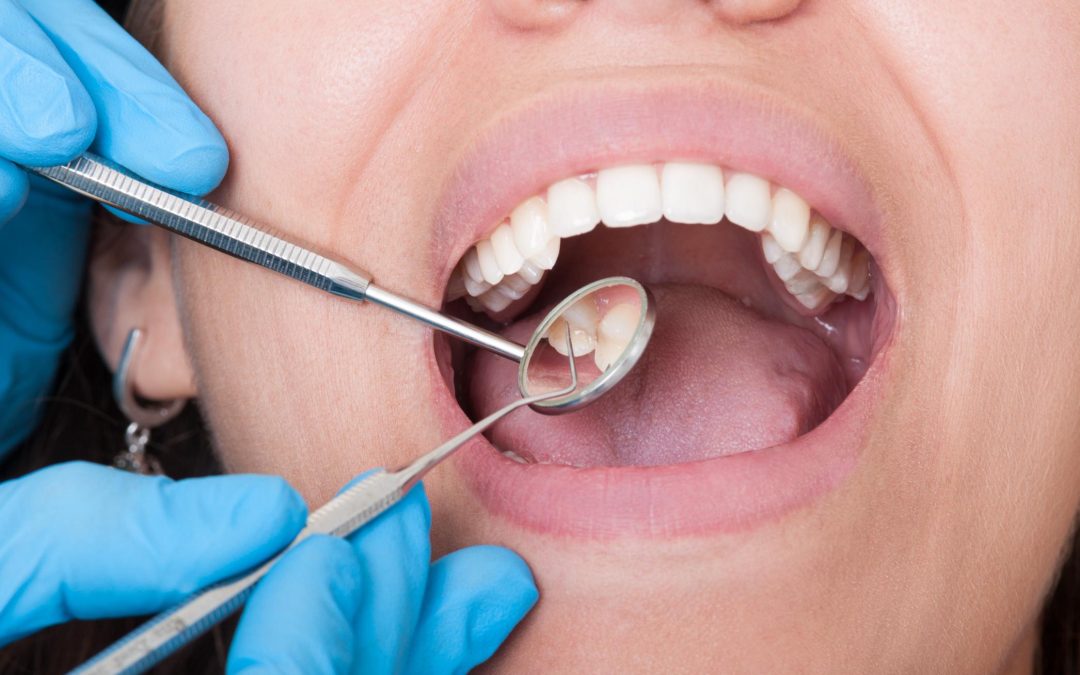 cavity care