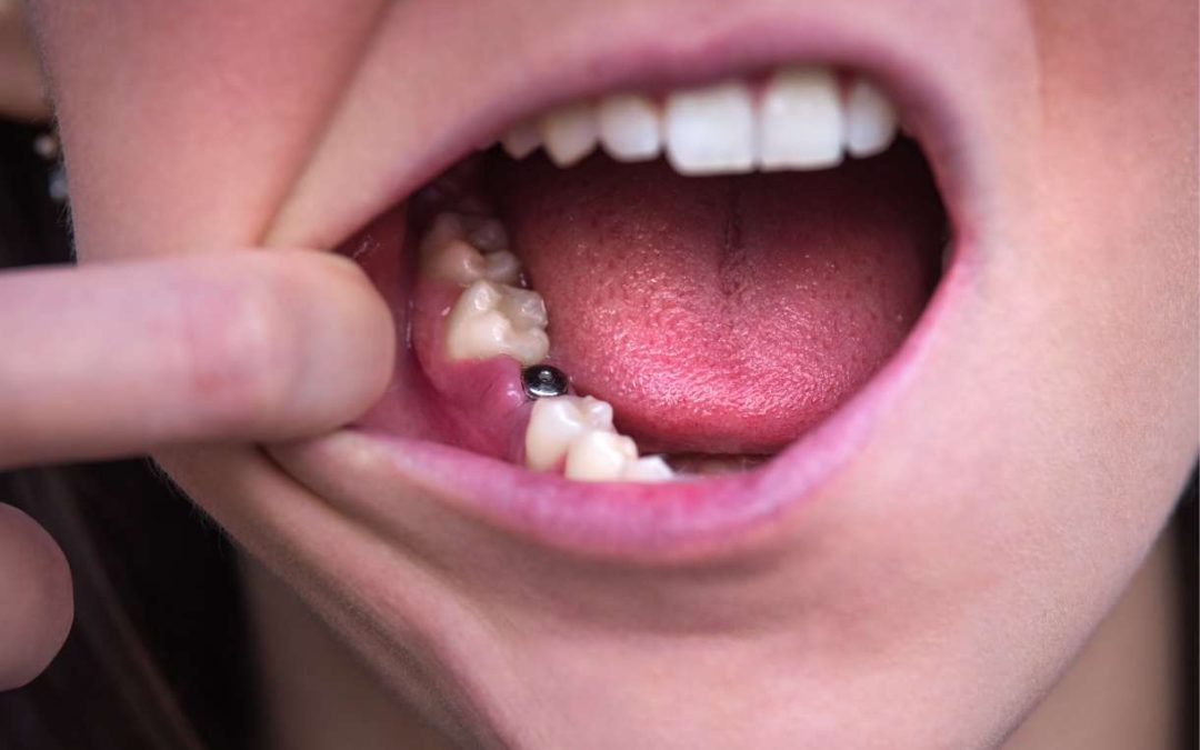The Importance of Replacing Missing Teeth: Options and Benefits