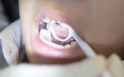 Crowns vs. Fillings: What’s the Difference?