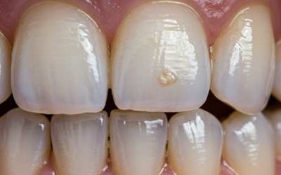 How to Tell If You Have a Cavity Before It Hurts