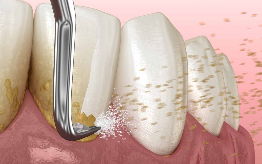 What Is Plaque, and How Can You Prevent It?