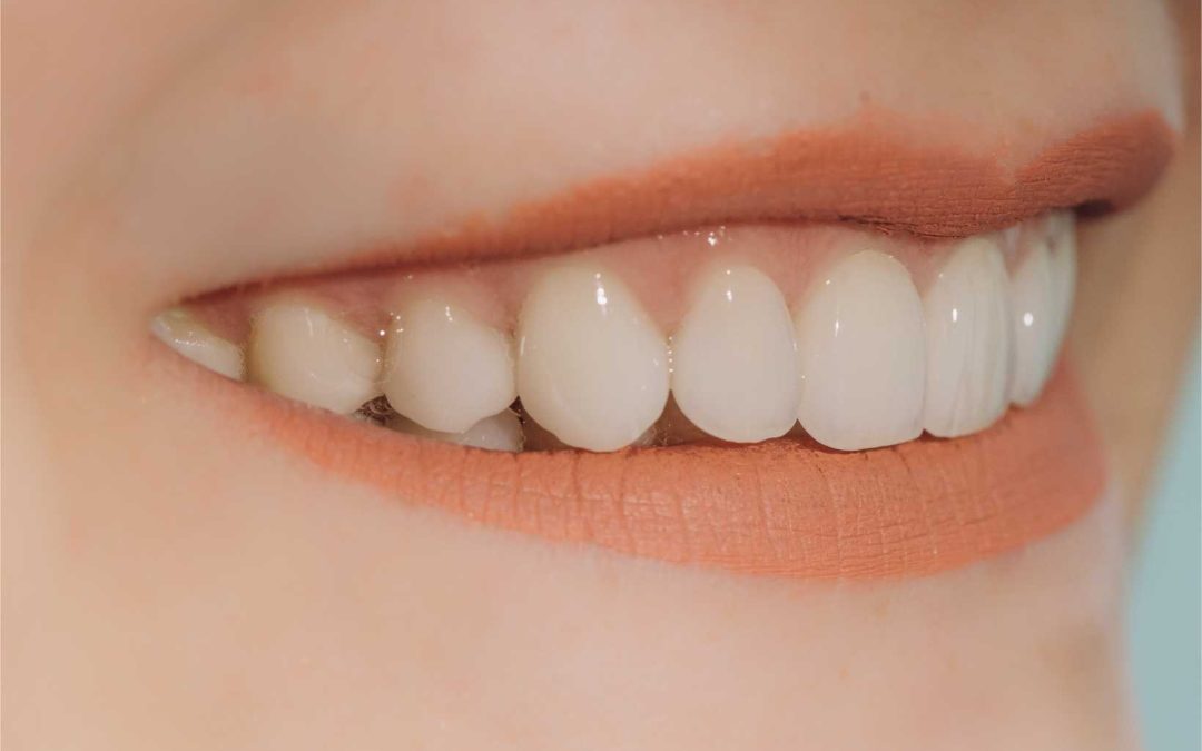 Porcelain vs Composite Veneers